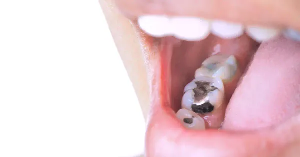 독성 치과용 아말감을 금지할 예정인 유럽연합